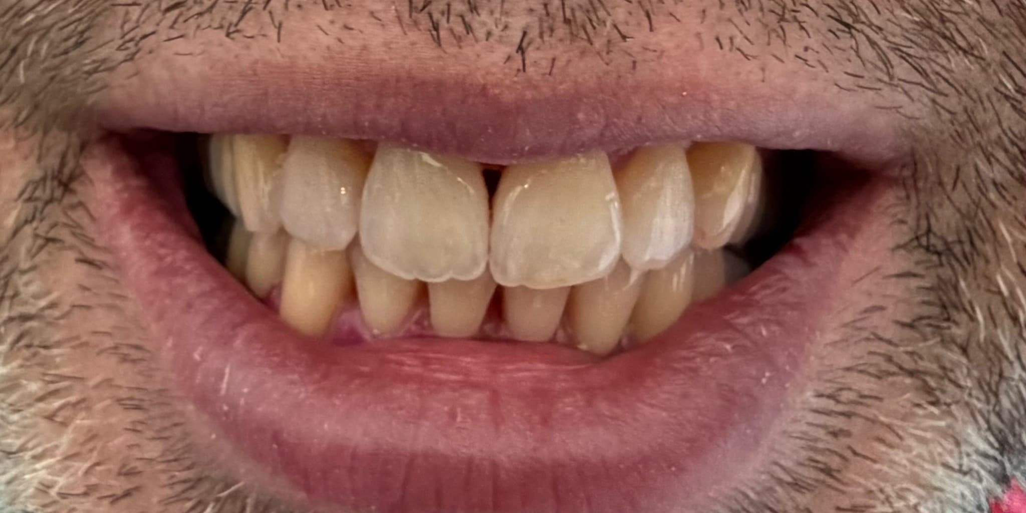 After: Smilewhite orthodontics