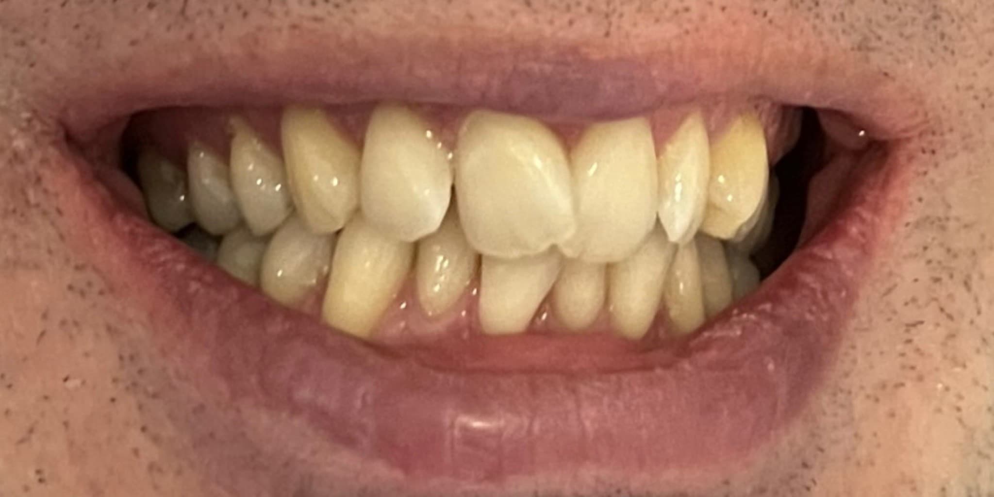 Before: Smilewhite orthodontics