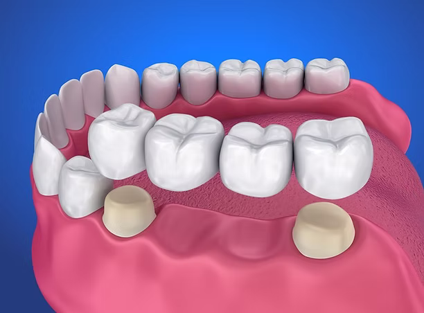 Photo representing dental appliances at A.G. Smiles
